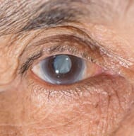 Best Cataract Care