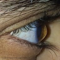 Best Cornea Care
