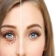 Eye Plastic Surgery
