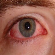 Glaucoma care