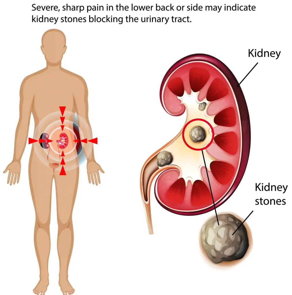 Kidney Stone