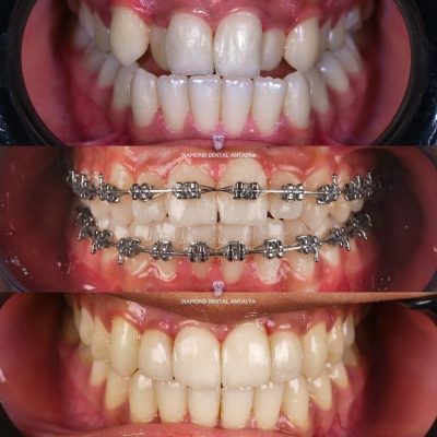 Teeth Braces