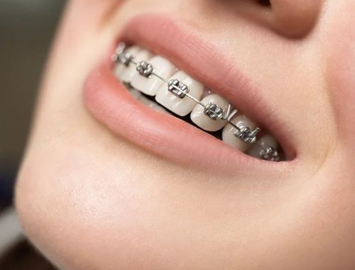 Dental Braces